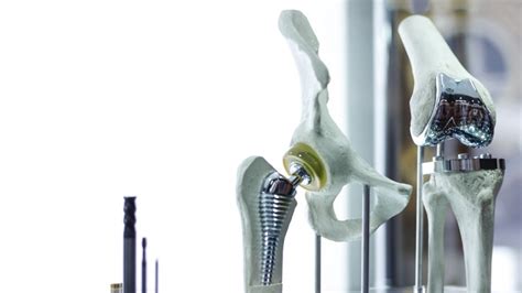 Osseointegratable Titanium Implants: A Revolution in Orthopedic and Dental Care!